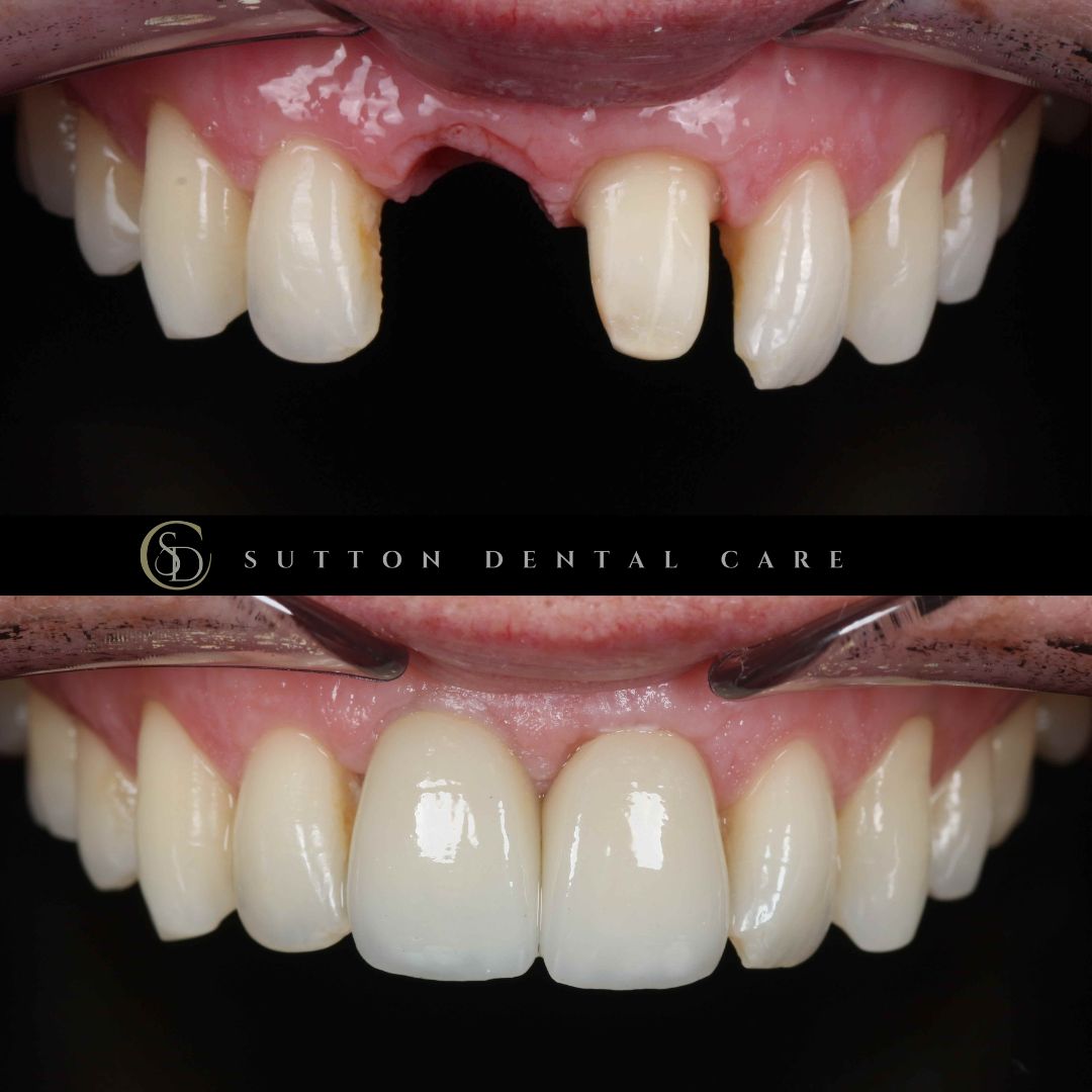 Whitening, Crown & Implant - Before & After