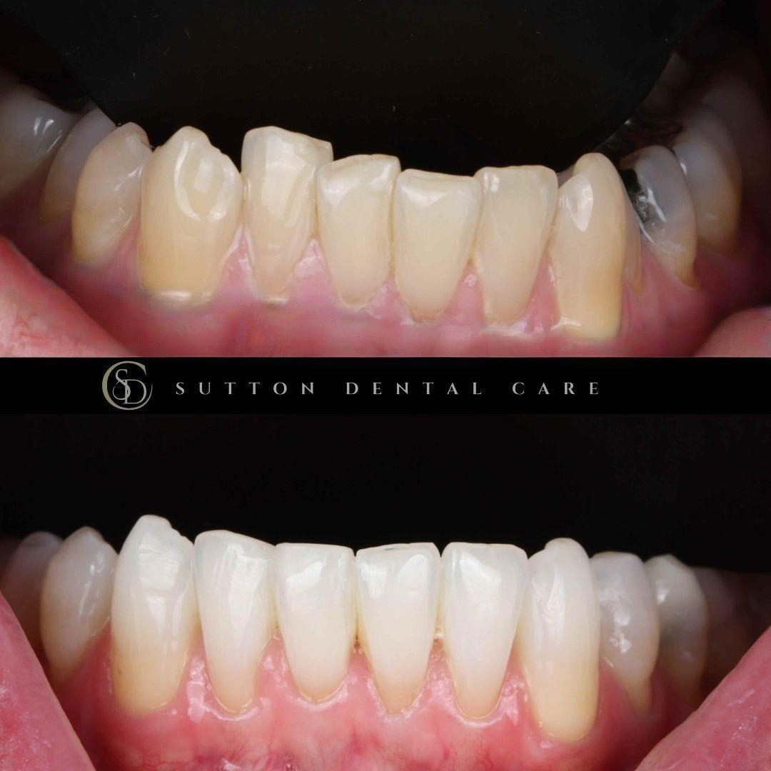 Composite Bonding - Before & After