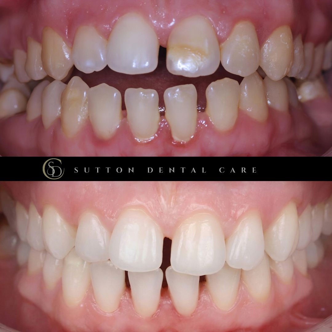 Whitening & Icon Treatment - Before & After