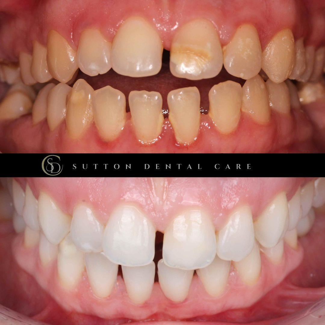 Whitening & Icon Treatment - Before & After